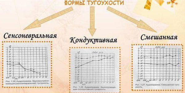 Лечение тугоухости