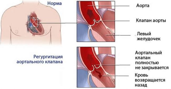Особенности регургитации трискупидального клапана 1 степени