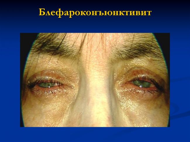 Кератит