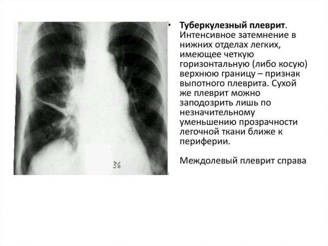 Как выглядит пневмония на снимке