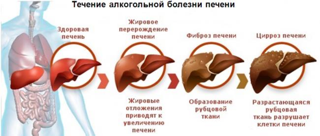 Лечение цирроза печени лекарственными препаратами: самые эффективные средства от цирроза