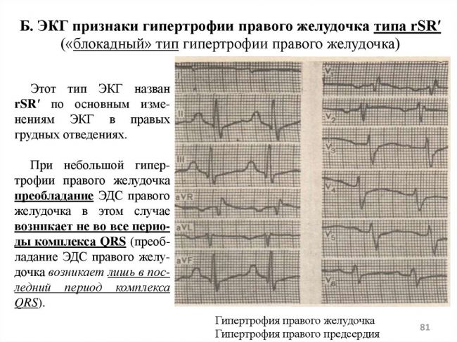 Что означает гипертрофия миокарда левого желудочка?
