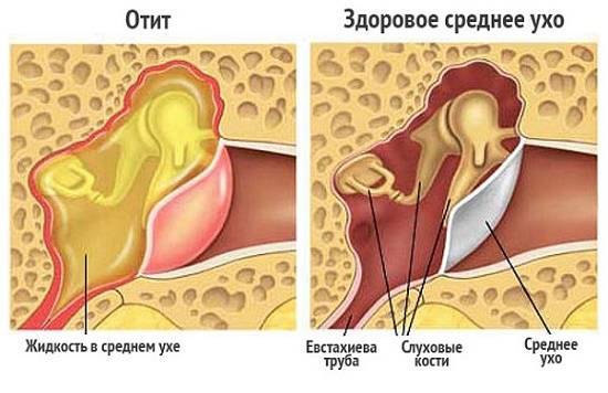 Как снять ушную боль у ребенка