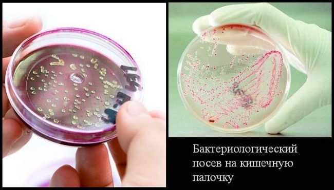 Escherichia coli в моче у грудничка или ребёнка, что это такое