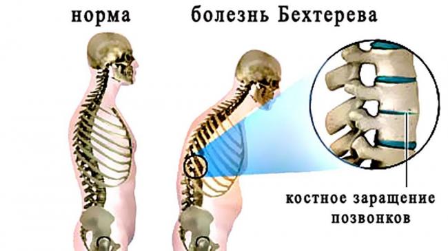 Анкилозирующий спондилит что это такое