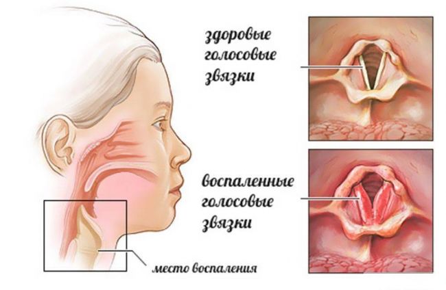 Доктор комаровский о ложном крупе у детей