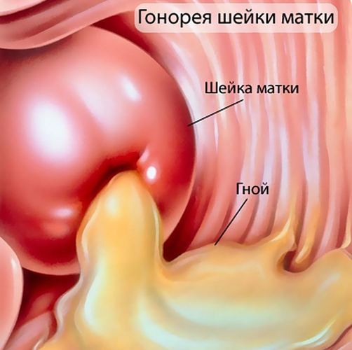 Уретрит: признаки, диагностика, как лечить