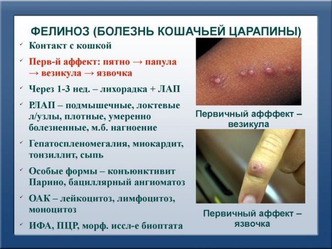 Болезнь кошачьих царапин