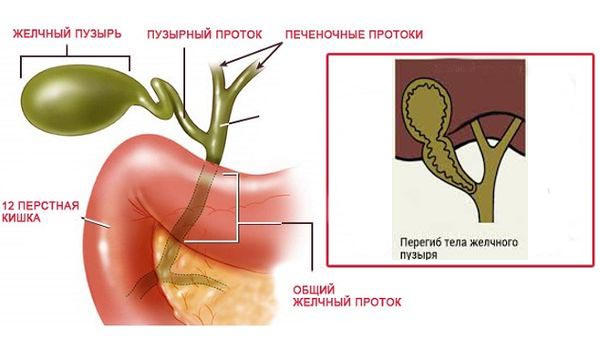 Хронический холецистит