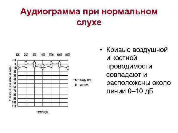 Нейросенсорная тугоухость (сенсоневральная) – симптомы и лечение. лечится или нет нейросенсорная потеря слуха?
