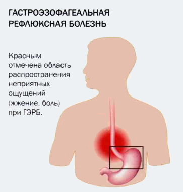 Гастроэзофагеальная рефлюксная болезнь: причины, лечение, профилактика, диагностика, симптомы