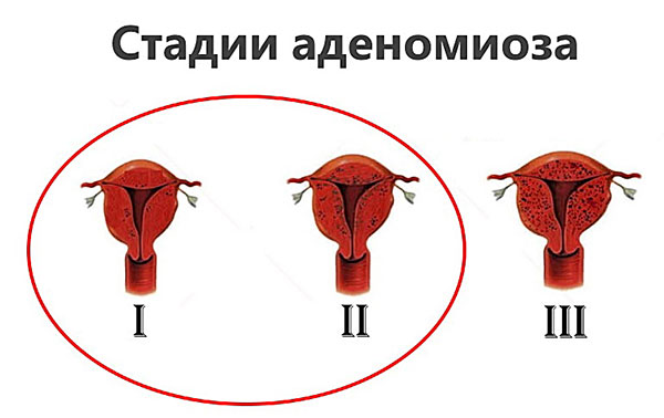 Признаки аденомиоза у женщины и способы его лечения