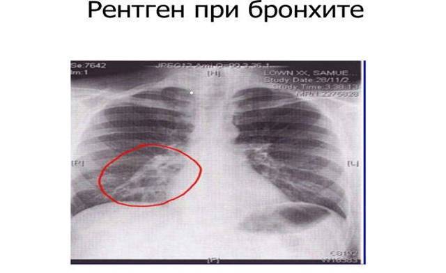 Причины и лечение хронического обструктивного бронхита у взрослых и детей