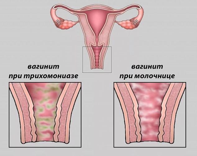 Вульвит у девочек: симптомы, причины, лечение, как выглядит вульвит у ребенка