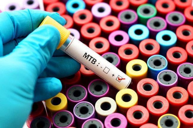 Симптомы на ранних стадиях и лечение туберкулеза легких у взрослых