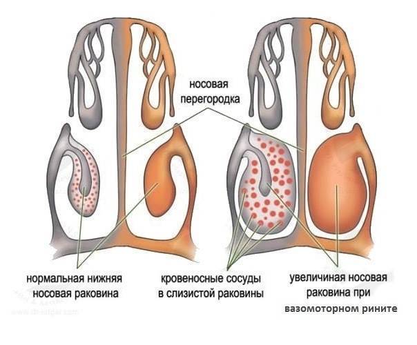 Если заложен нос и капли не помогают: что делать?