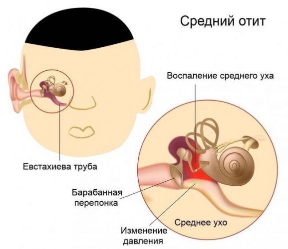 Заложено ухо. причины заложенности уха. что делать при заложенности уха? :: polismed.com