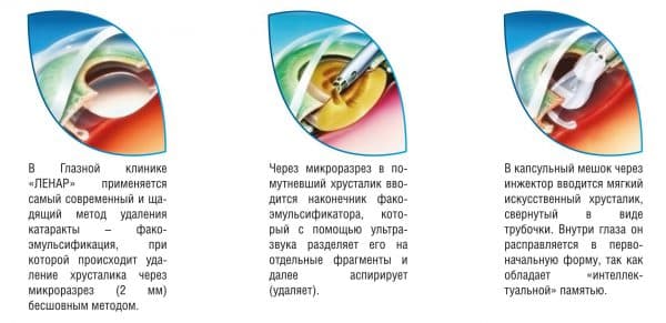 Как вести себя после операции по удалению катаракты глаза (замене хрусталика на иол)