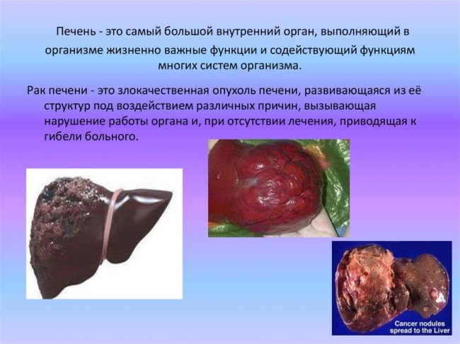Диагностика и лечение кавернозной гемангиомы печени
