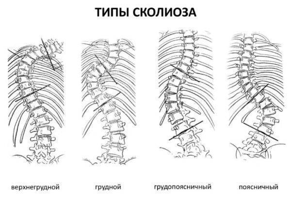 Как лечить сколиоз 2 степени у взрослых
