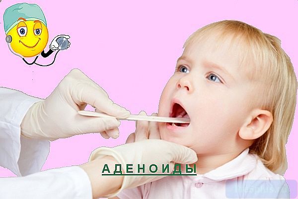 Кашель при аденоидите 2 степени у ребенка
