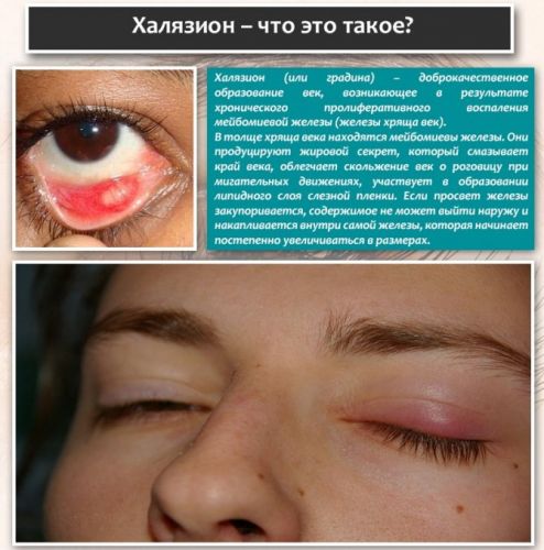 Как мы победили халязион!)))) - запись пользователя настя (djeksi) в дневнике - babyblog.ru