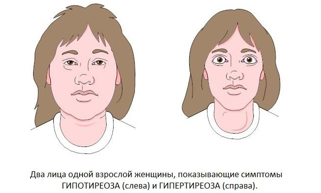 Нарушения в работе щитовидной железы – симптомы и признаки развития