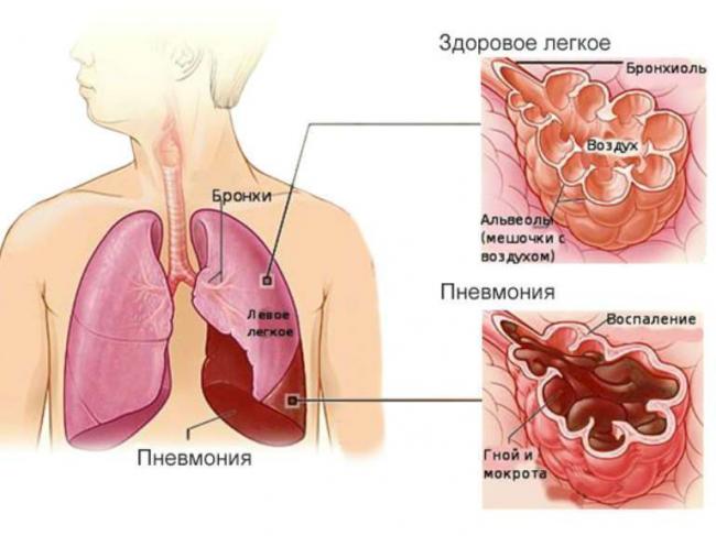 Признаки воспаления легких у взрослого без температуры: возможно ли это?