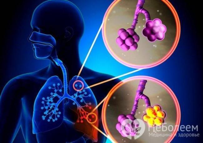 Почему развивается воспаление легких у лежачих пожилых людей?