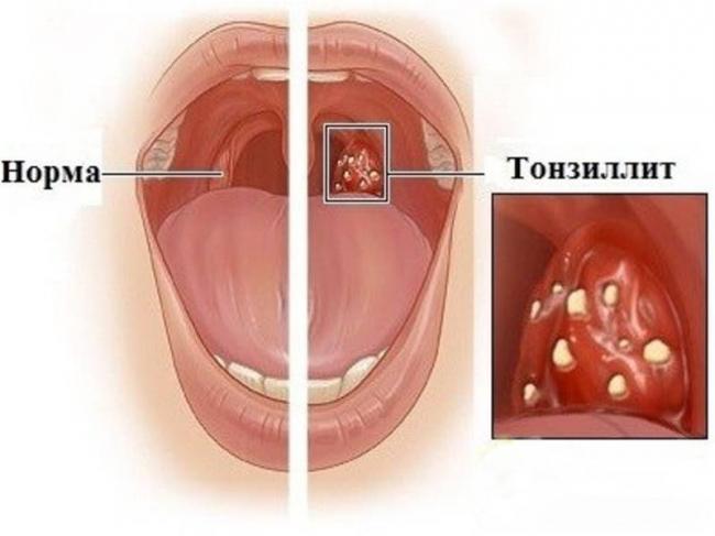 Как победить хронический тонзиллит – схема лечения миндалин