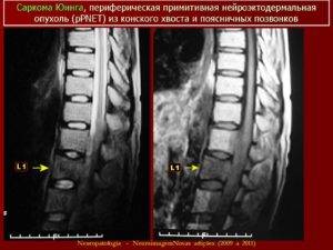 Саркома позвоночника