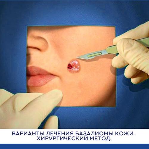 Что такое базалиома кожи носа и как от неё избавиться