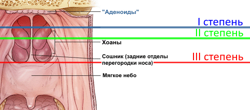 Аденоиды у детей: основные симптомы и способы лечения