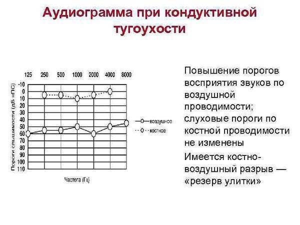 Тугоухость 1 степени – что это такое, лечится ли у взрослых потеря слуха