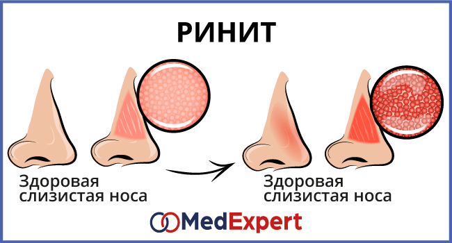 Симптомы и лечение аллергического ринита (насморка) у взрослых