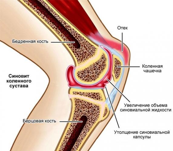 Синовит. причины, симптомы, виды, лечение и реабилитация :: polismed.com
