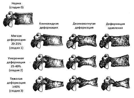 Что такое клинья позвоночника