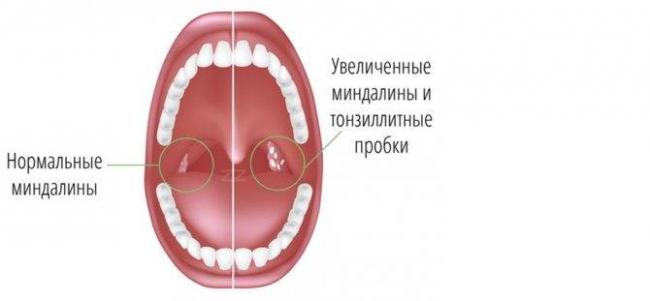 Чем вызваны гнойные пробки в горле и как их лечить