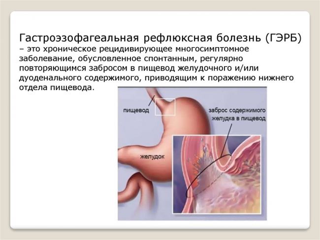 Гастроэзофагеальная рефлюксная болезнь: симптомы, лечение, диагностика