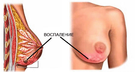 Мастит