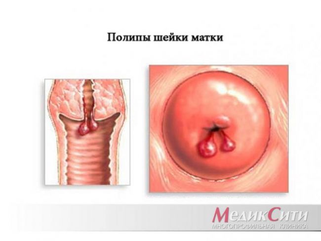 Полип шейки матки может перейти в рак?