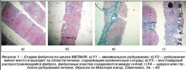 Фиброз печени 4 степени сколько живут
