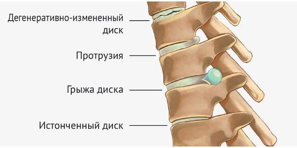 Болит поясница после сна: подробное описание причин