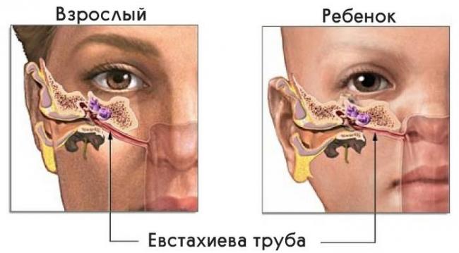 Как избавиться от гнойных пробок в горле, их причины