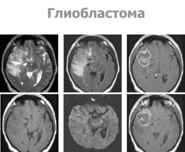 Глиобластома головного мозга: причины, симптомы, диагностика, лечение, прогноз жизни