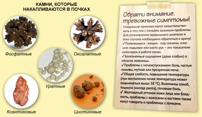 Мочекаменная болезнь