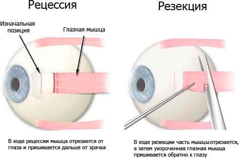 Косоглазие сходящиеся и его лечение