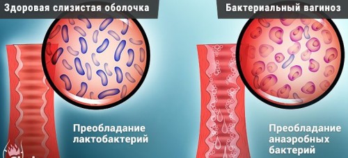 Бактериальный вагиноз: причины, симптомы, диагностика и лечение