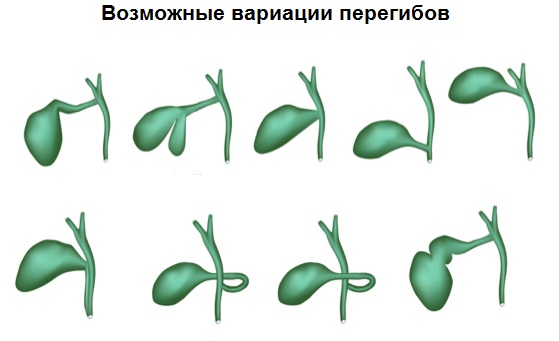Перегиб желчного пузыря: симптомы, лечение, причины и последствия