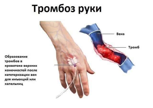 Что такое флебит?
